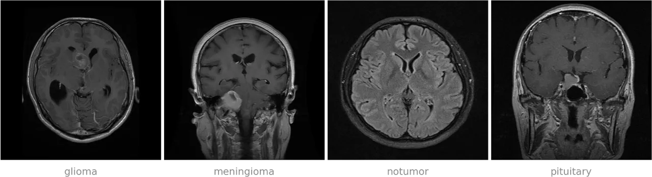 Four brain scans side by side, labelled glioma, meningioma, notumor and pituitary. The glioma is an axial slice with a small bright ring near the centre and dark ventricles. The meningioma is a coronal slice with a rounded bright mass low on the left near the skull base. The notumor slice is symmetric with clear grey and white matter and no lesion. The pituitary is a coronal slice with a small bright mass at the centre of the skull base, eye sockets and sinuses visible.