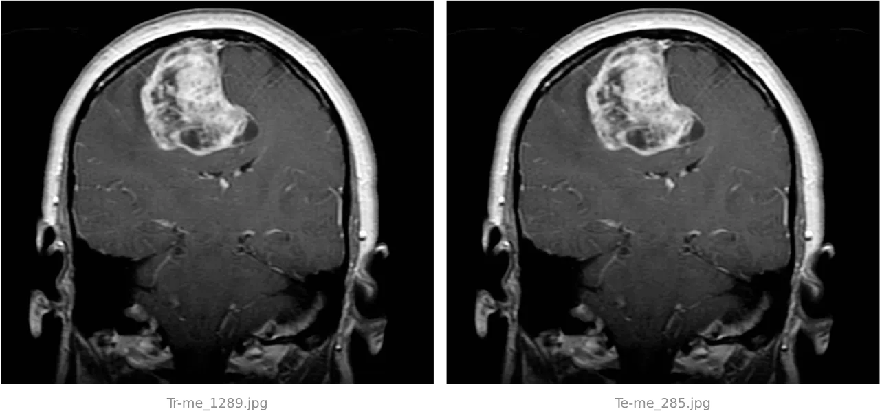 Two identical coronal brain scans side by side. Each shows a head in cross section with a large bright irregular mass in the upper left of the brain, about a third the width of the skull, with a darker cavity at its lower edge. The filename beneath the left panel reads Tr-me_1289.jpg and beneath the right, Te-me_285.jpg.